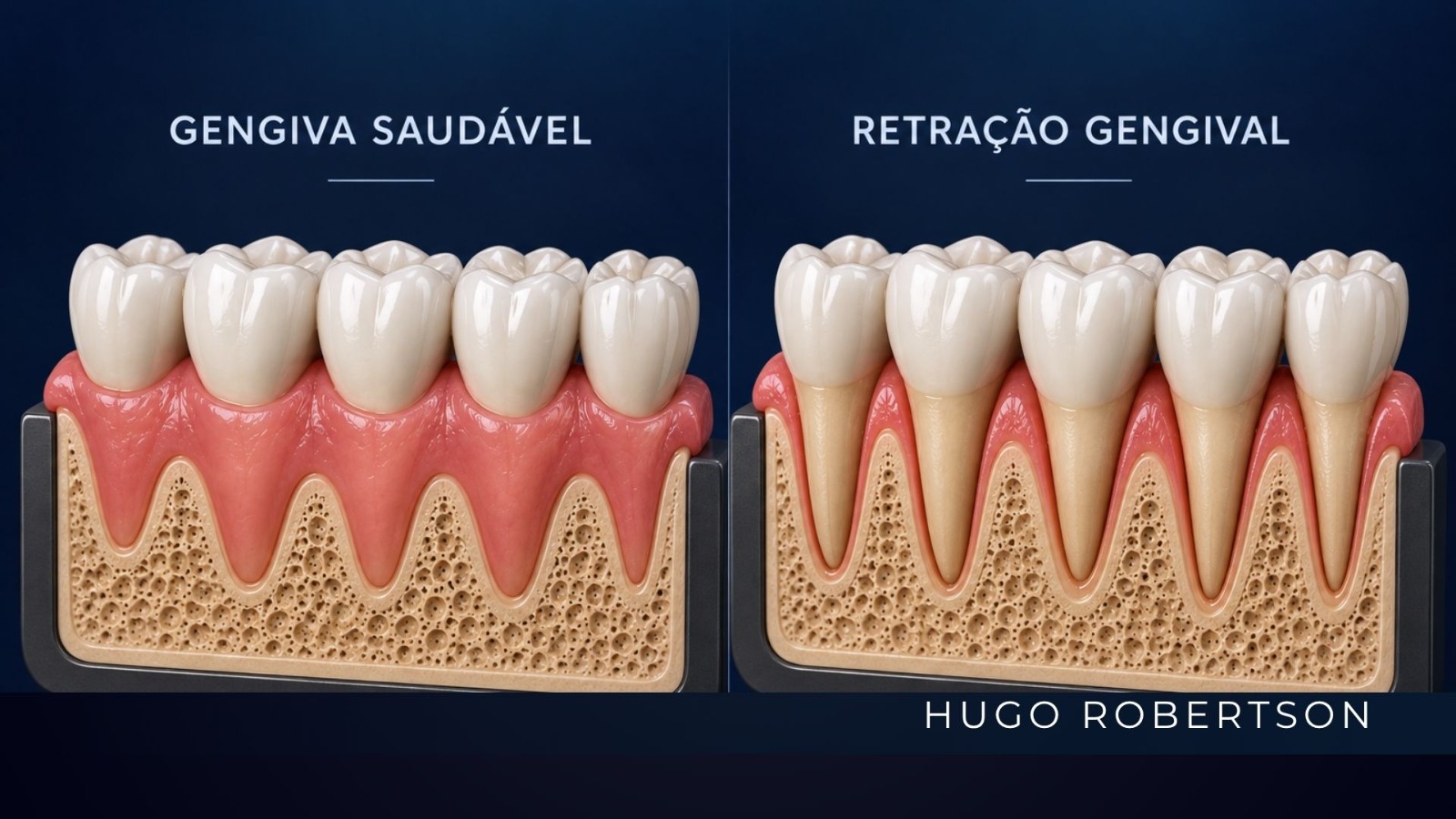 Retração gengival: causas e o que fazer