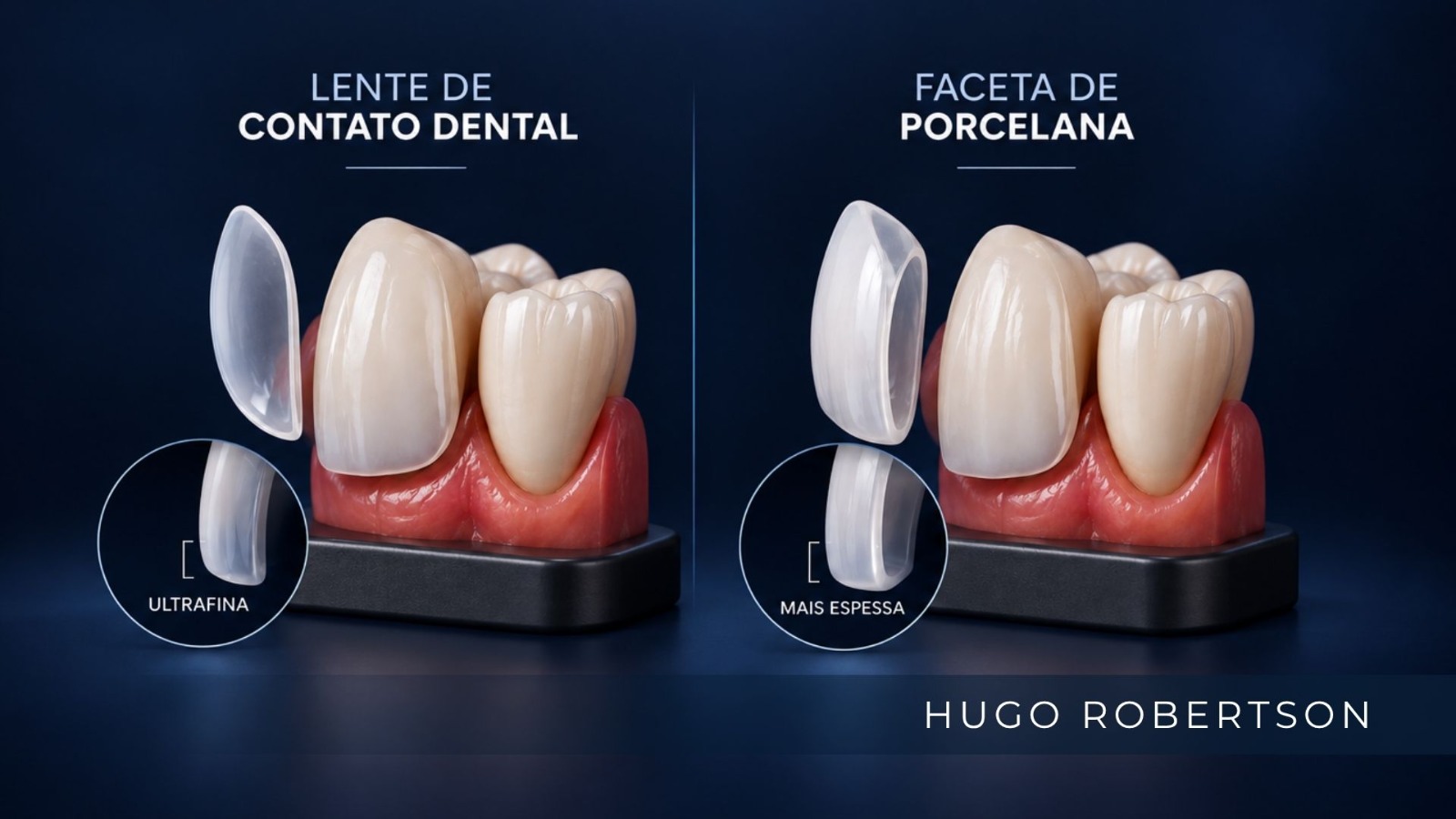 Lente de contato dental e faceta de porcelana: qual a diferença