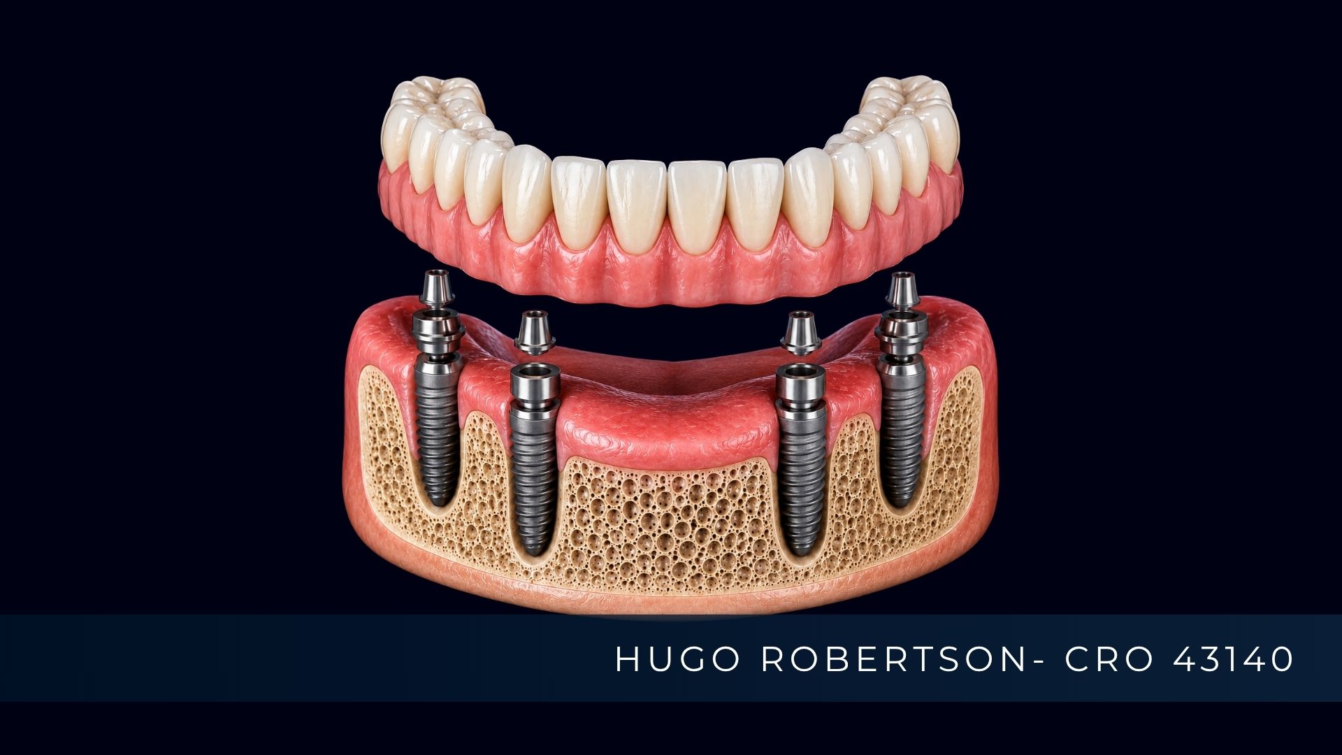 o que e protese protocolo.jpg   ALT  Ilustração mostrando uma Prótese Protocolo fixada sobre implantes dentários
