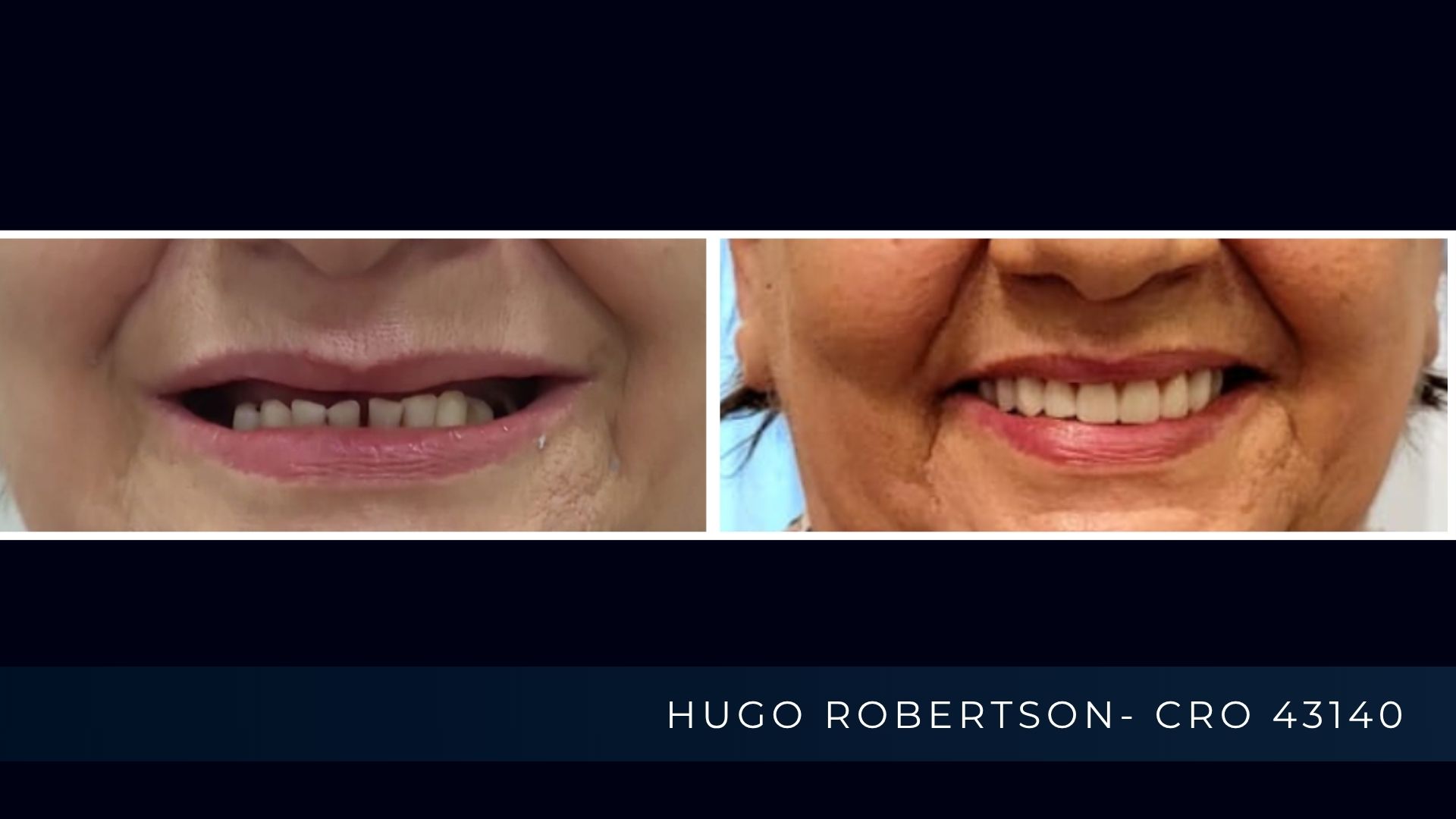 protese protocolo sorriso fixo.jpg   ALT  Sorriso reabilitado com Prótese Protocolo fixa sobre implantes