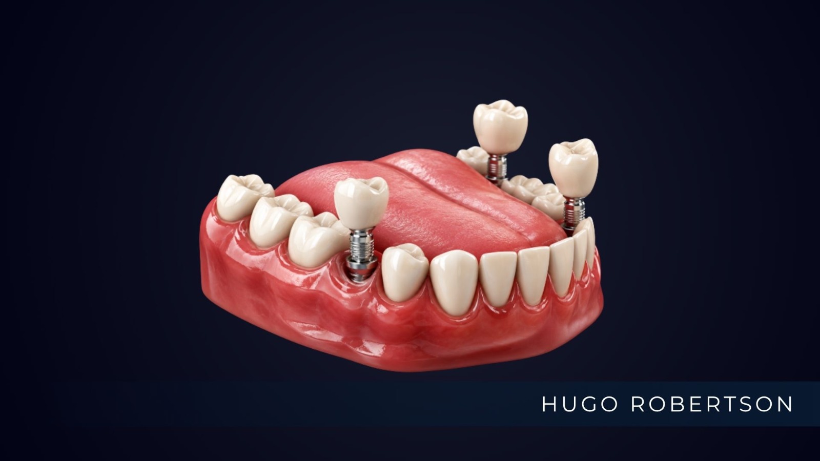 Avaliação odontológica com planejamento para implante dentário
