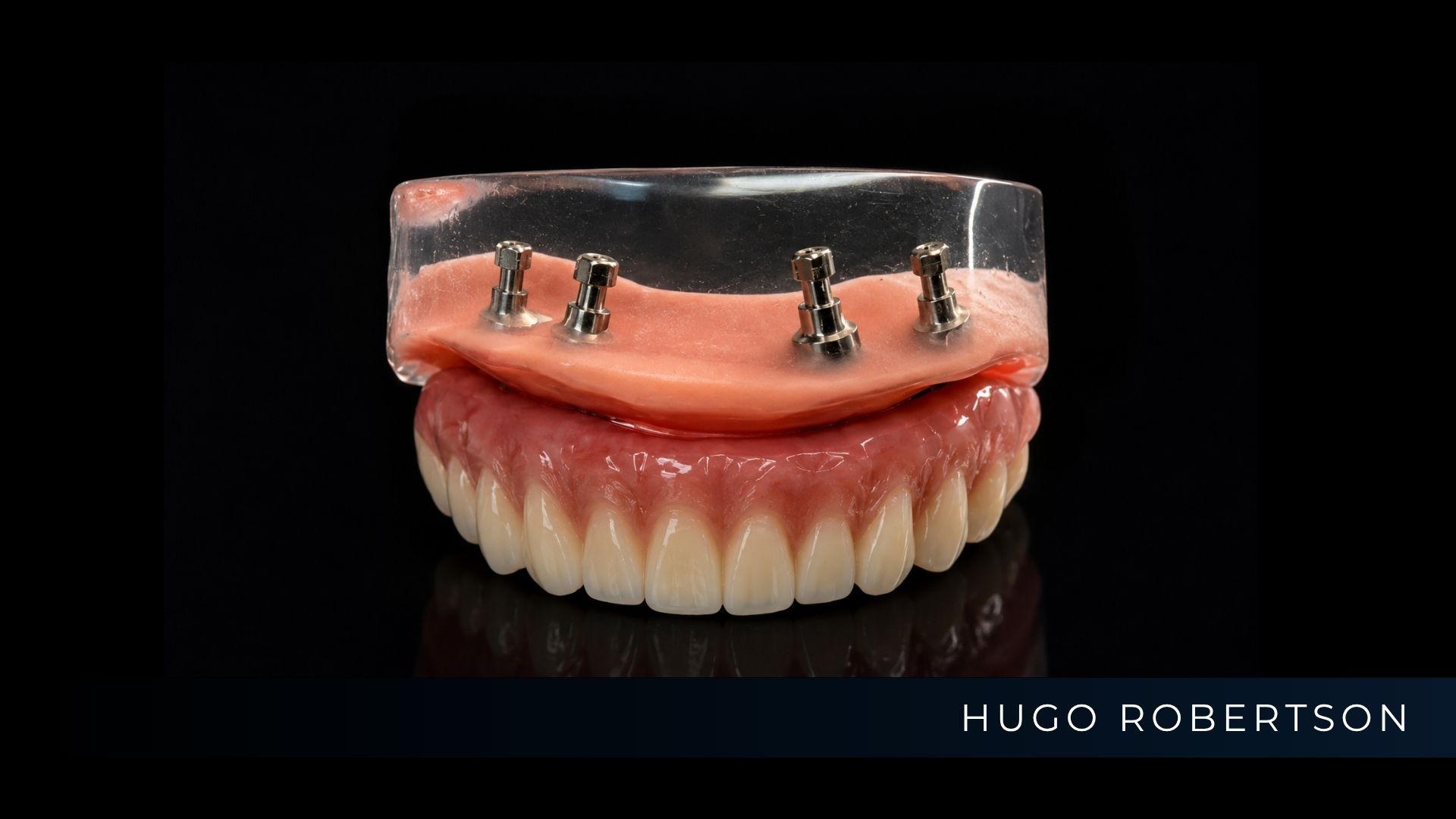 Planejamento digital de Prótese Protocolo mostrando o posicionamento de implantes na Odontoclinic Vila Mariana.