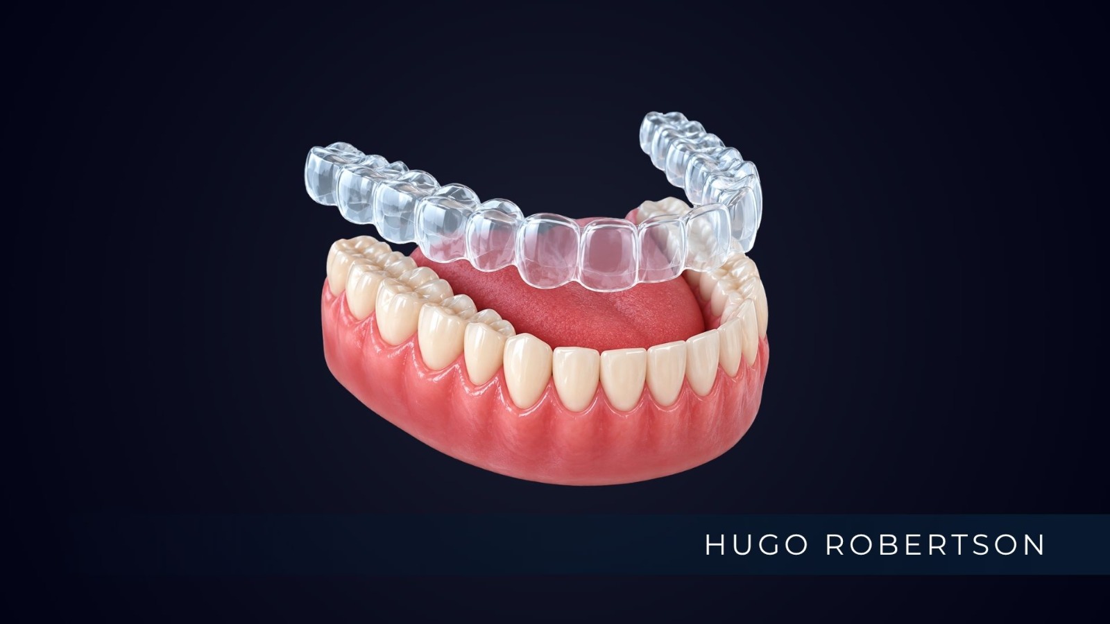 Aparelho invisível funciona mesmo? Como o alinhador move os dentes