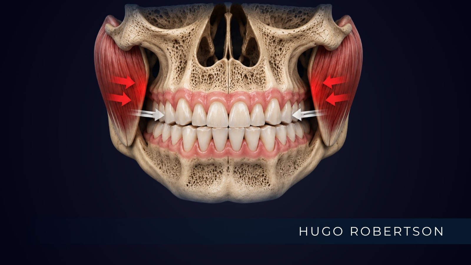 Bruxismo: como afeta dentes, próteses e implantes