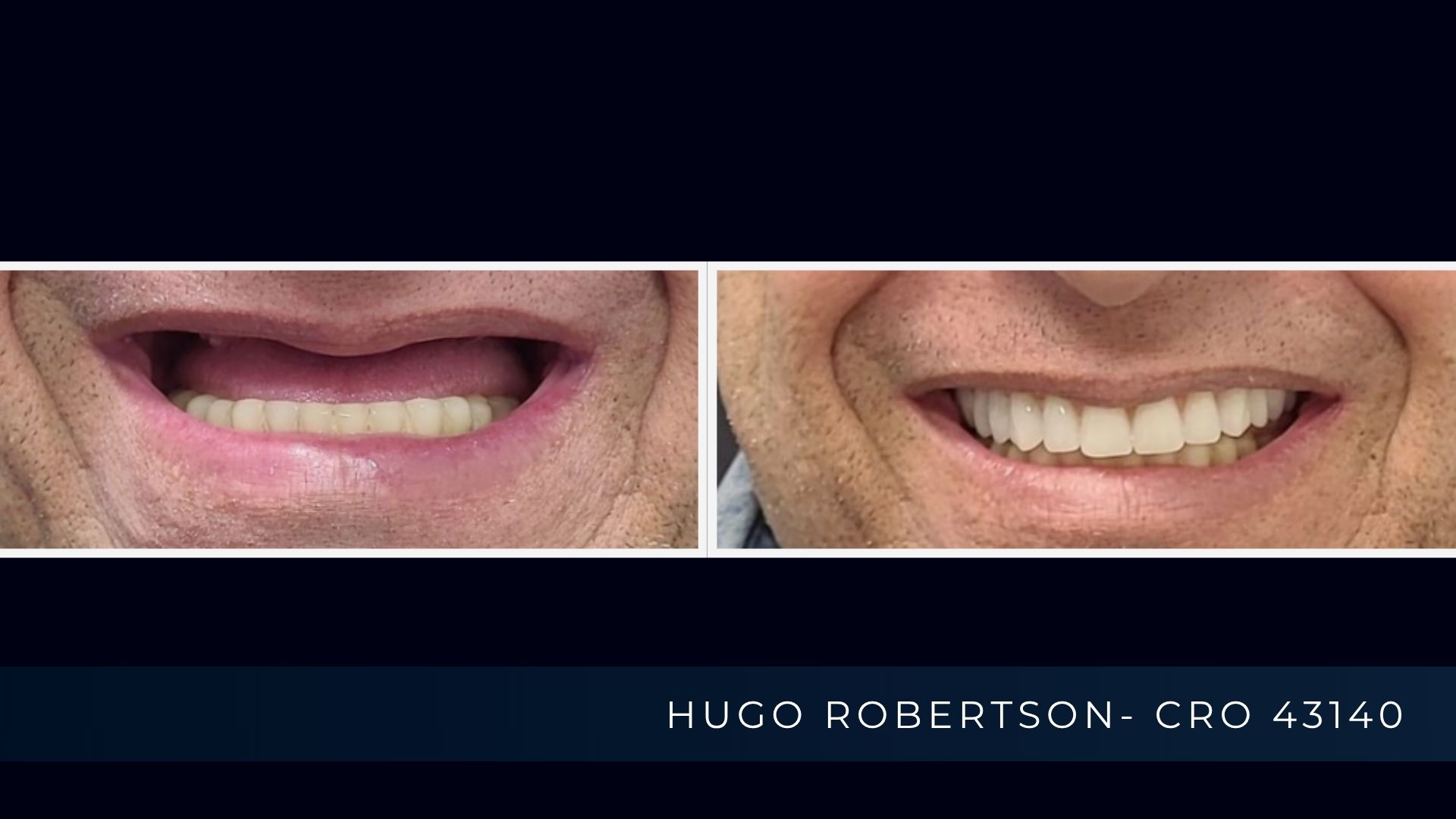 protocolo fixo 12h.jpg   ALT  Reabilitação com dentes fixos utilizando protocolo de carga imediata