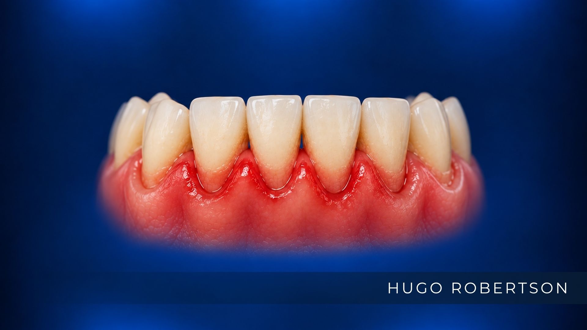 Gengivite: sintomas, causas e tratamento