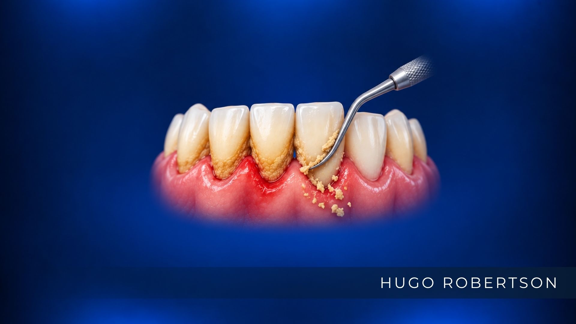 Raspagem periodontal: como funciona e quando é necessária