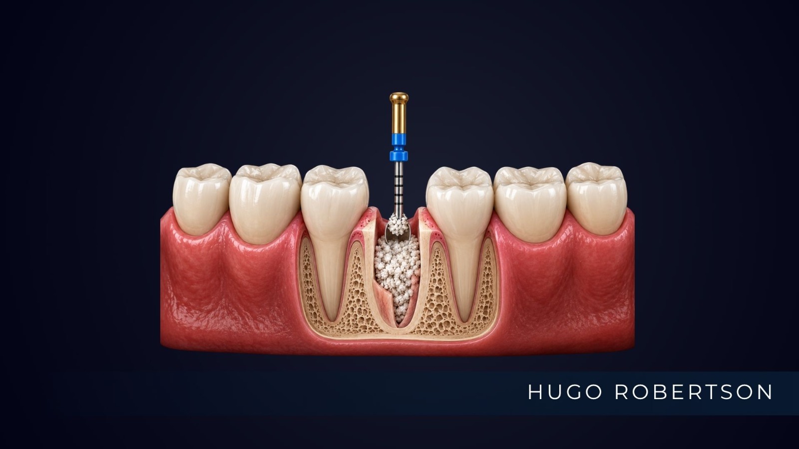 Enxerto ósseo para implante dentário: quando é necessário?