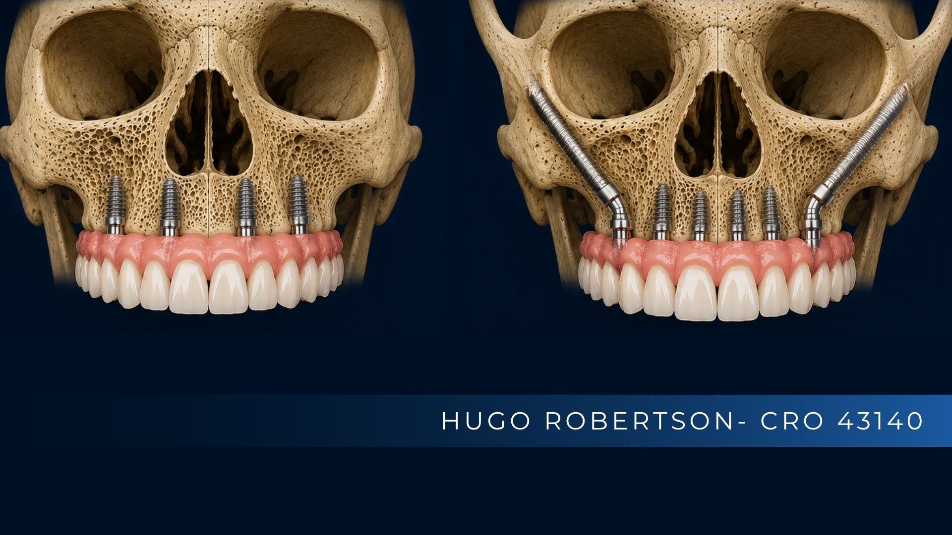 implante convencional x zigomatico.jpg ALT Diferença entre implante dentário convencional e implante zigomático