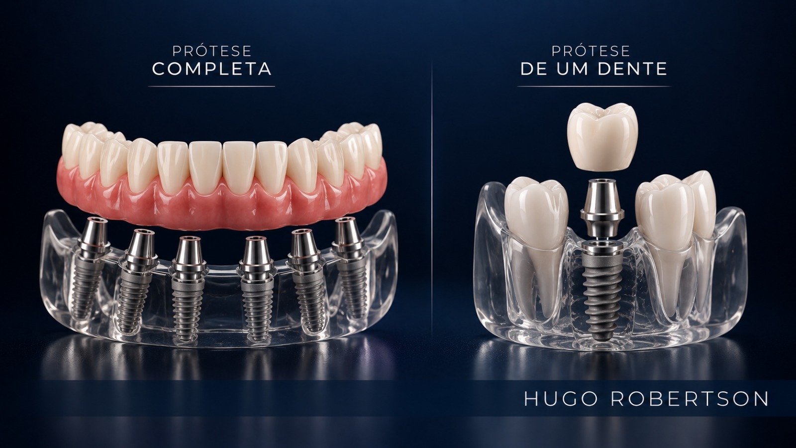 Prótese sobre implante: o que é, quais os tipos e como funciona
