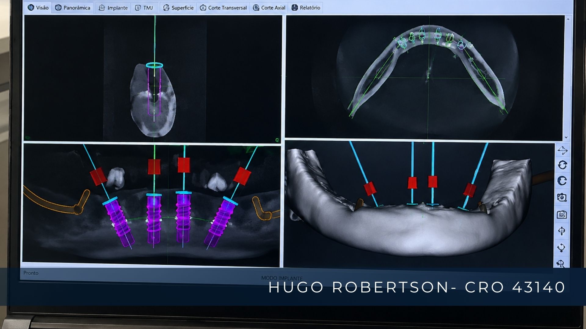 planejamento implantes protese protocolo.jpg
