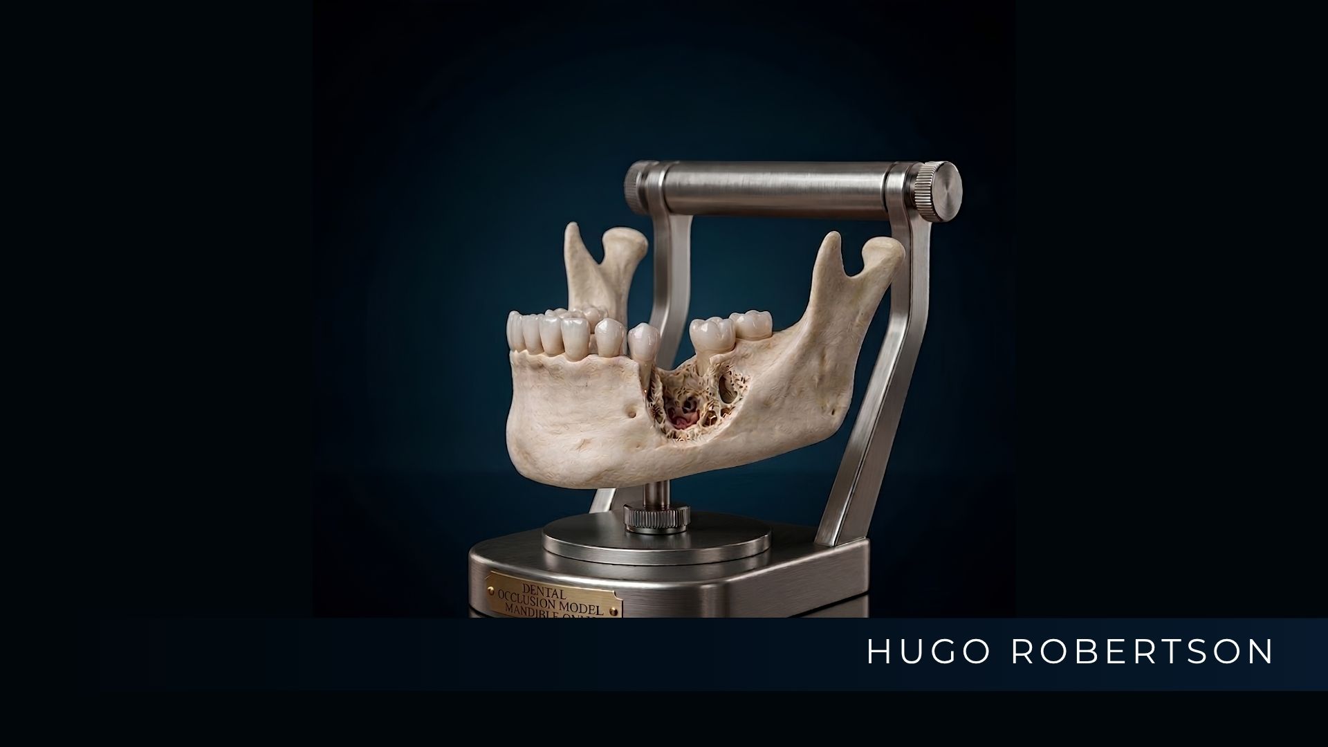 Dr. Hugo Robertson analisando o planejamento de um implante unitário para substituir um dente perdido