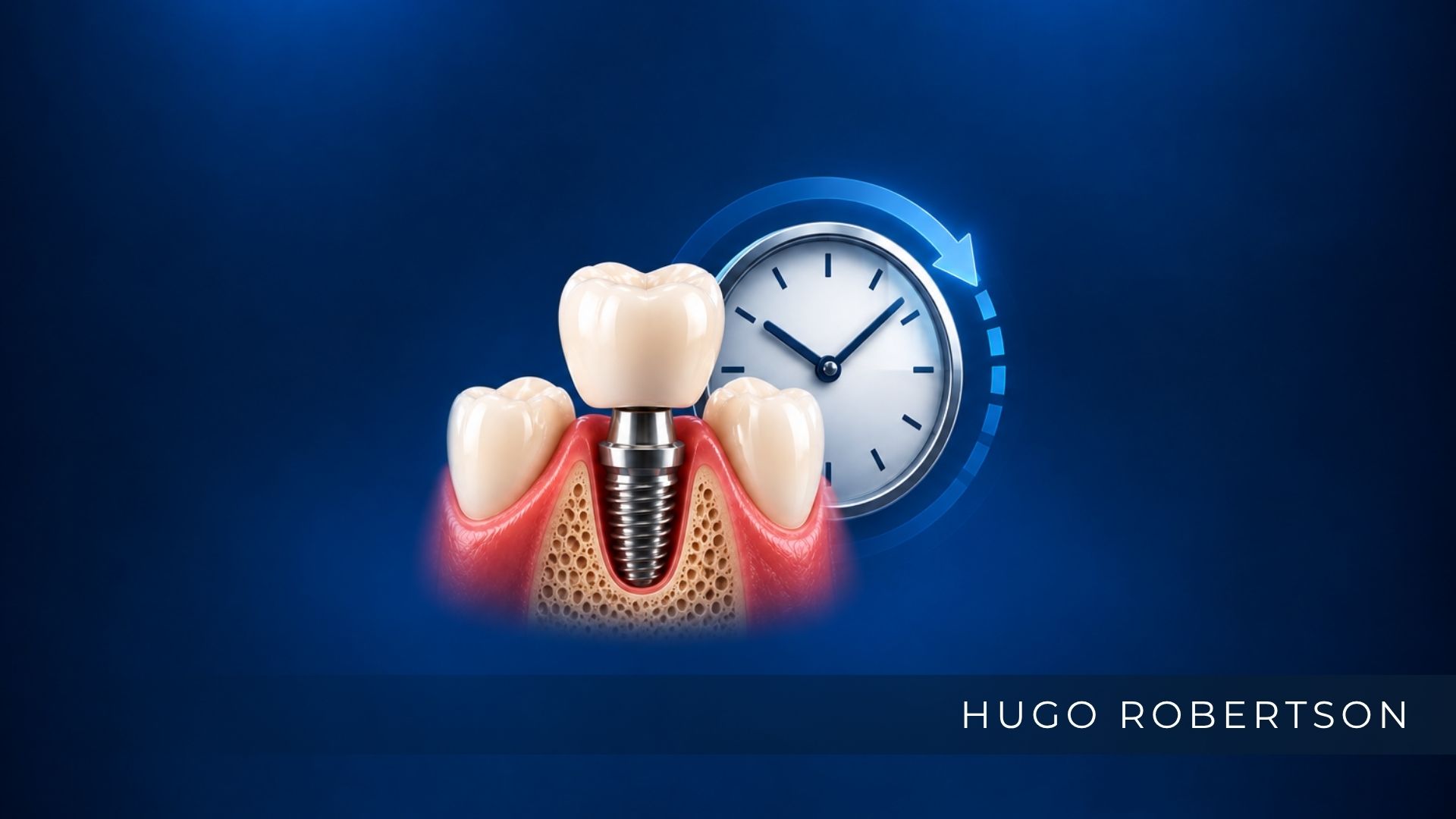 Quanto Tempo Demora a Cicatrização do Implante Dentário?