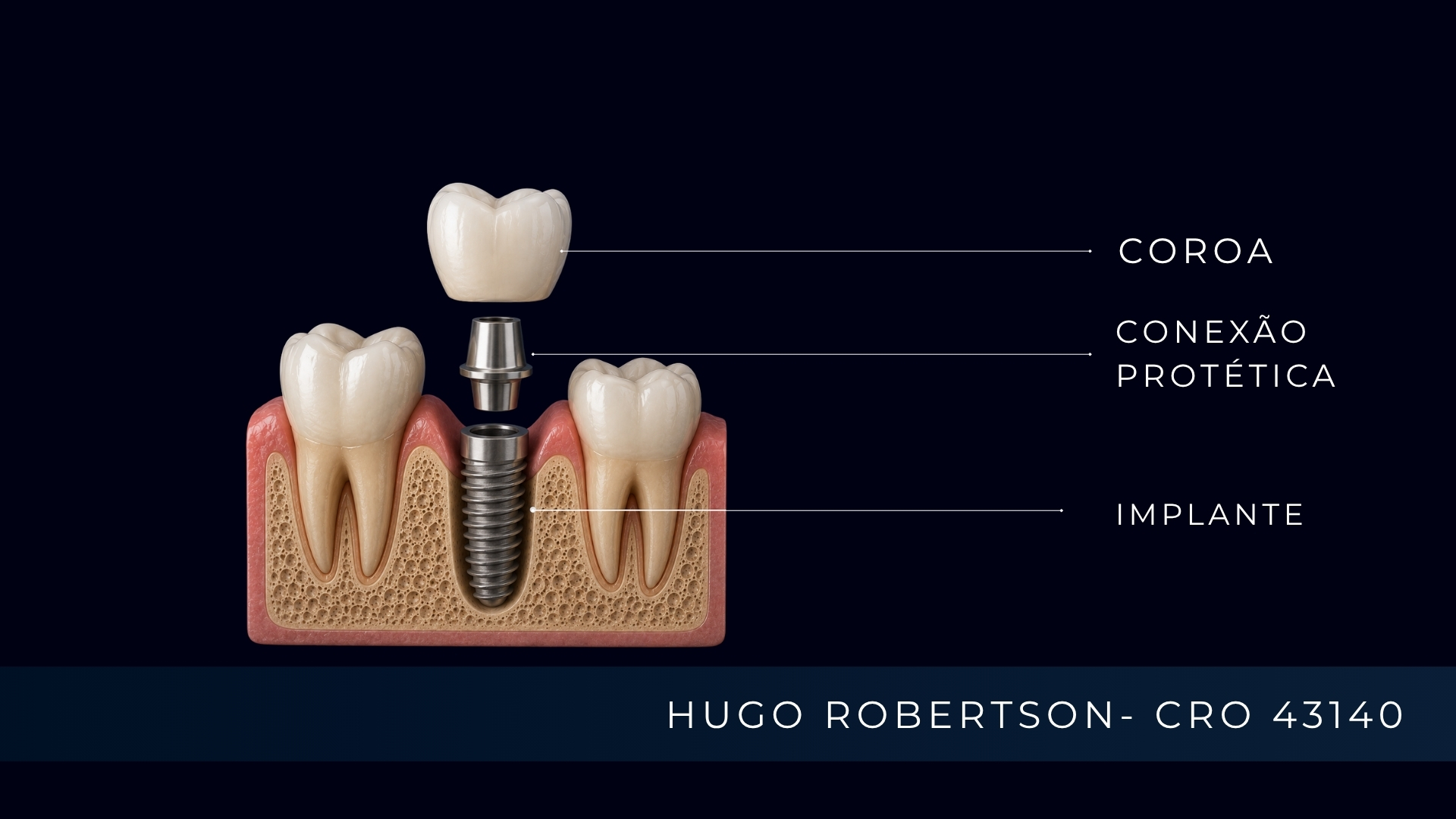 como-funciona-implante-dentario