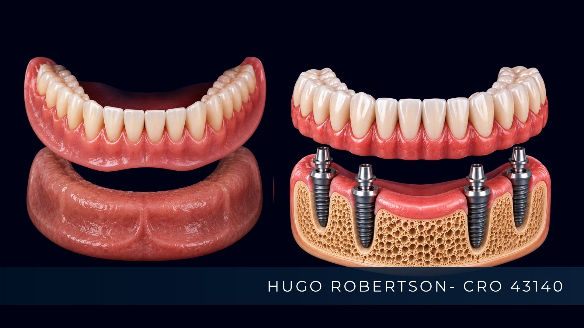dentadura x protese protocolo
