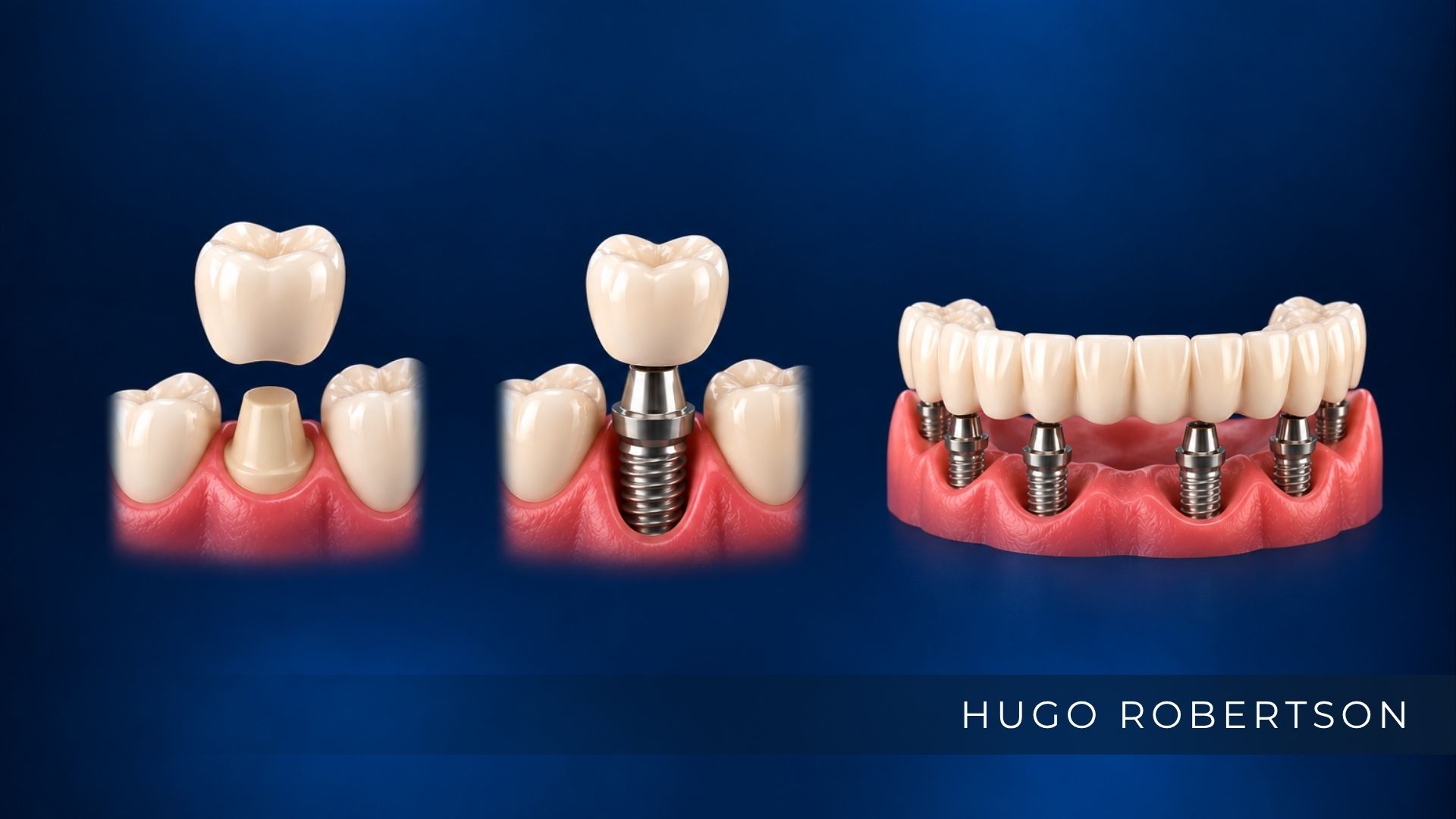 Prótese Fixa: o que é, tipos e quando é indicada