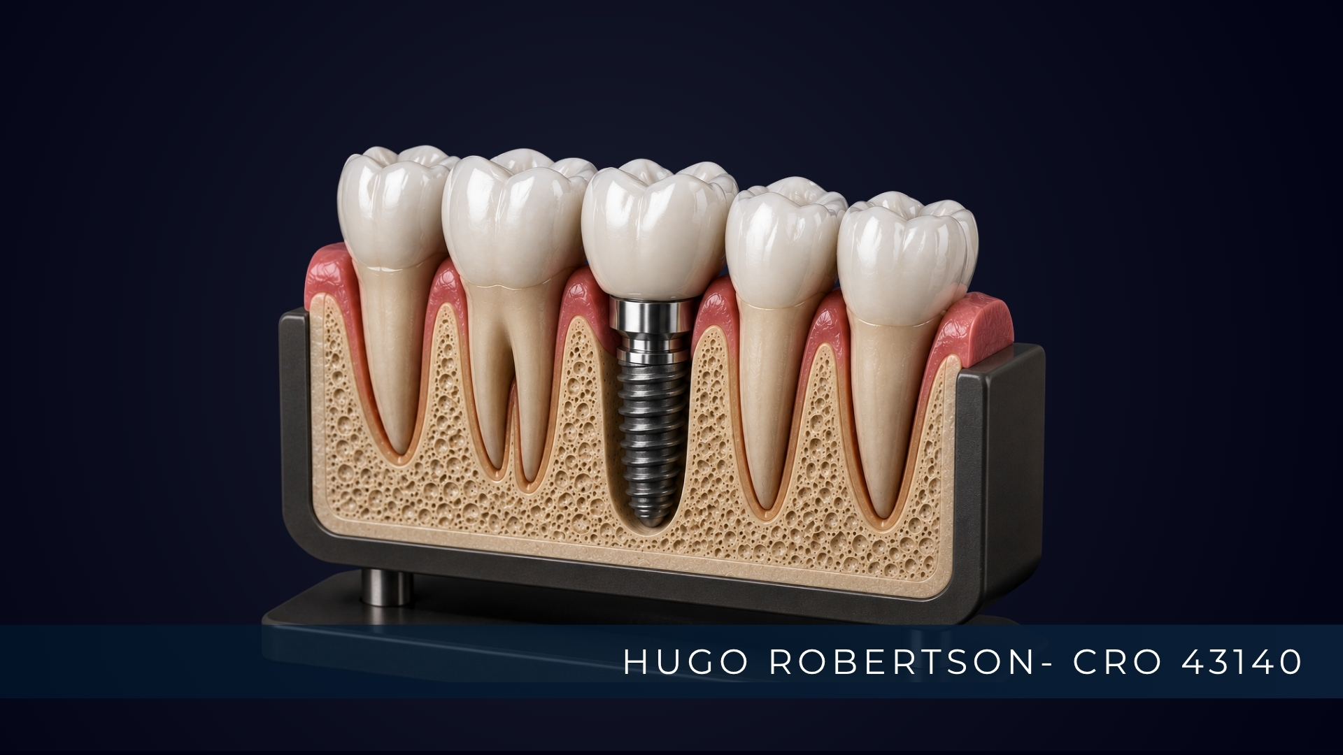 Implante Dentário: como funciona, para quem é indicado e quais são as etapas?